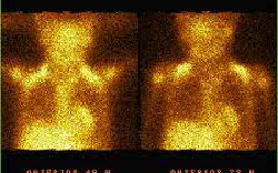 images/exams/Cintilografia Cardíaca com Gálio 67.jpeg