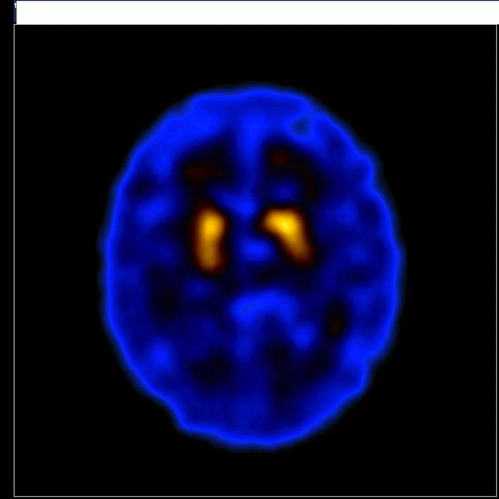 images/exams/Cintilografia Cerebral com Trodat.webp