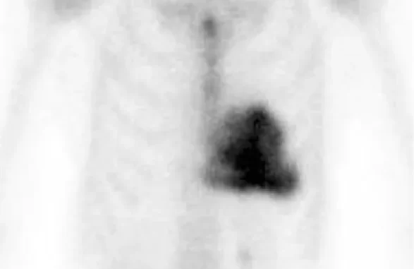 images/exams/Cintilografia com Pirofosfato para a Pesquisa de Amiloidose.webp