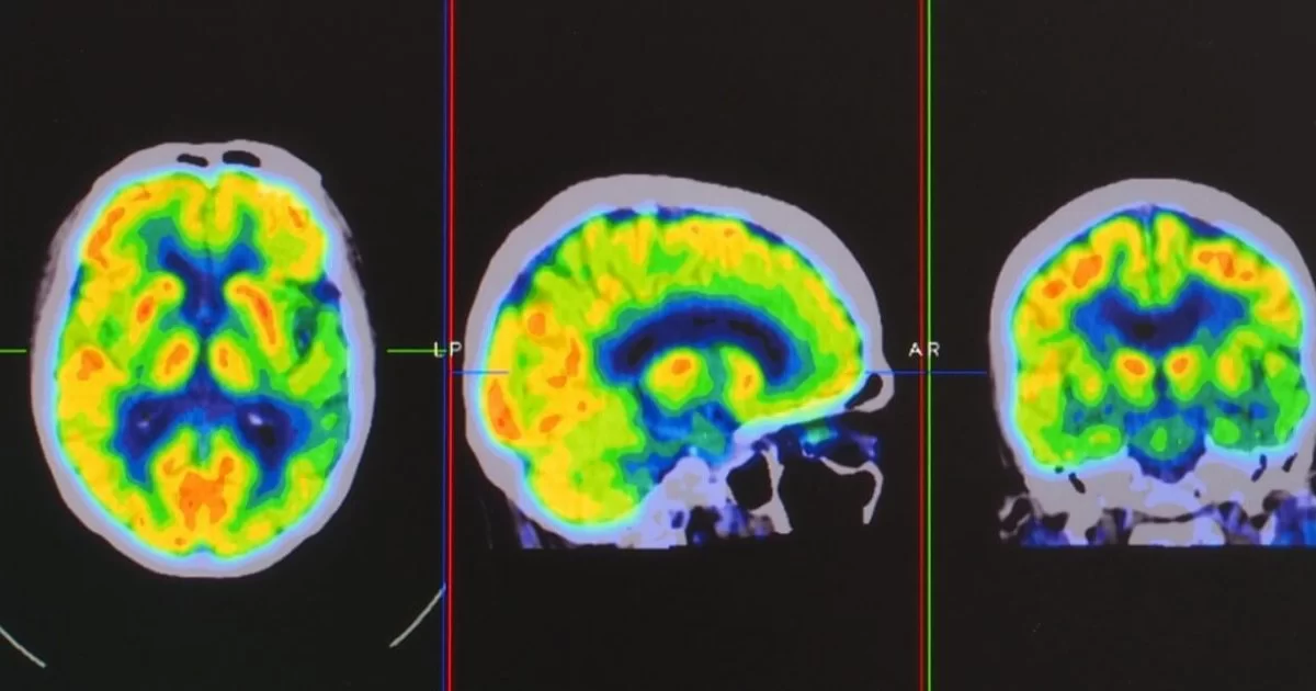 PET CT Neurológico