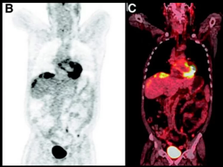 PET CT Oncológico Com Thyrogen®