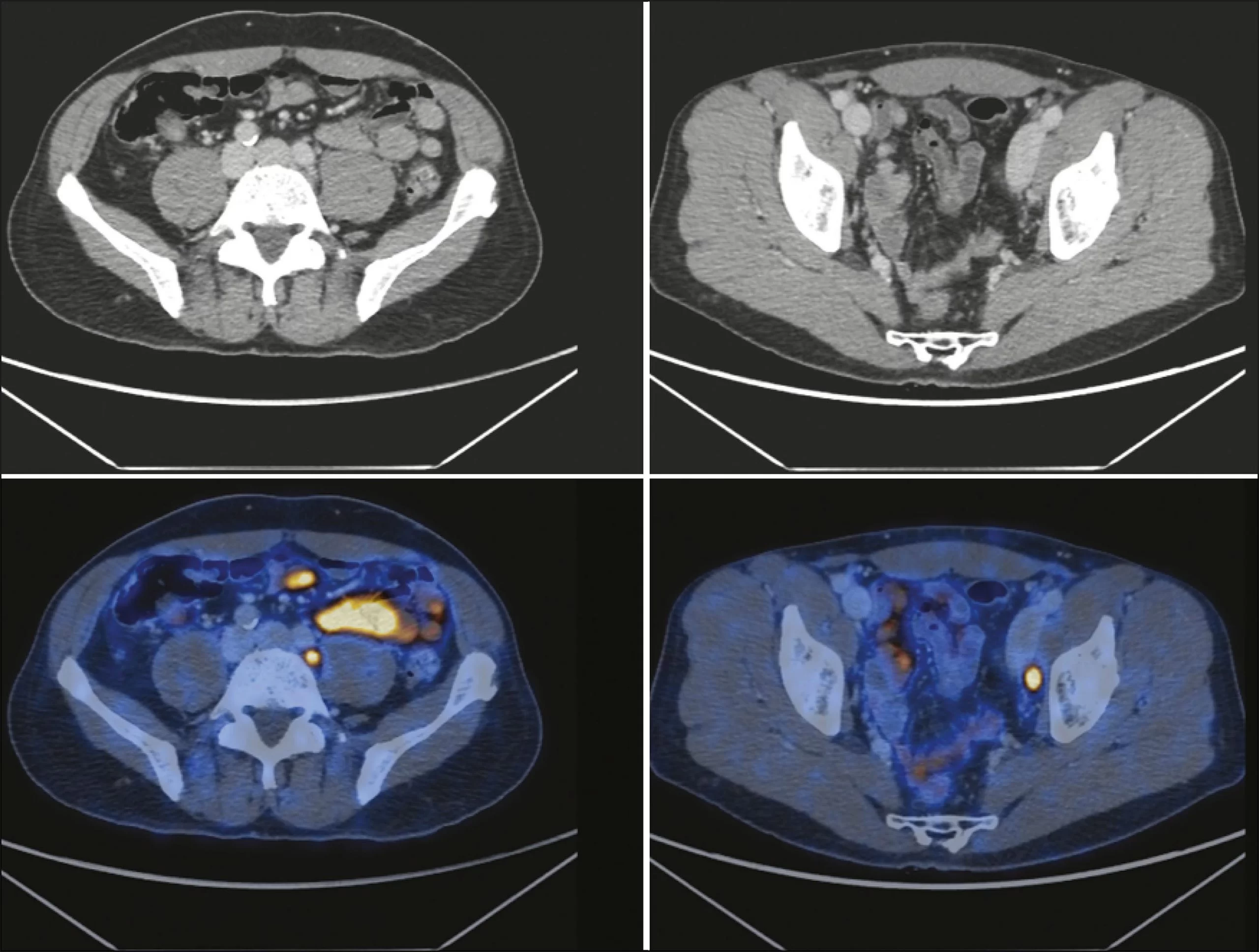PET CT Com PSMA