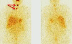 images/exams/Pesquisa de Corpo Inteiro com Radioiodo I131 e I123.webp