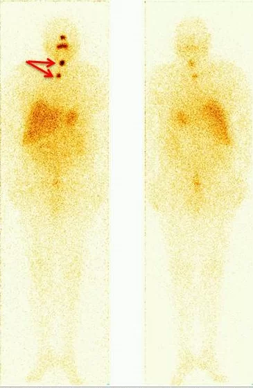 images/exams/Pesquisa de corpo inteiro com radioiodo ou PCI com Iodo 131 ou Iodo 123 com Thyrogen®.webp