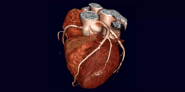 Angiotomografia De Coronárias