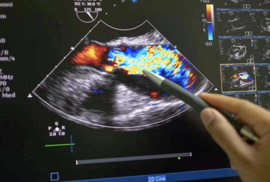 Doppler Colorido Da Aorta Abdominal, Artérias Ilíacas E Ramos