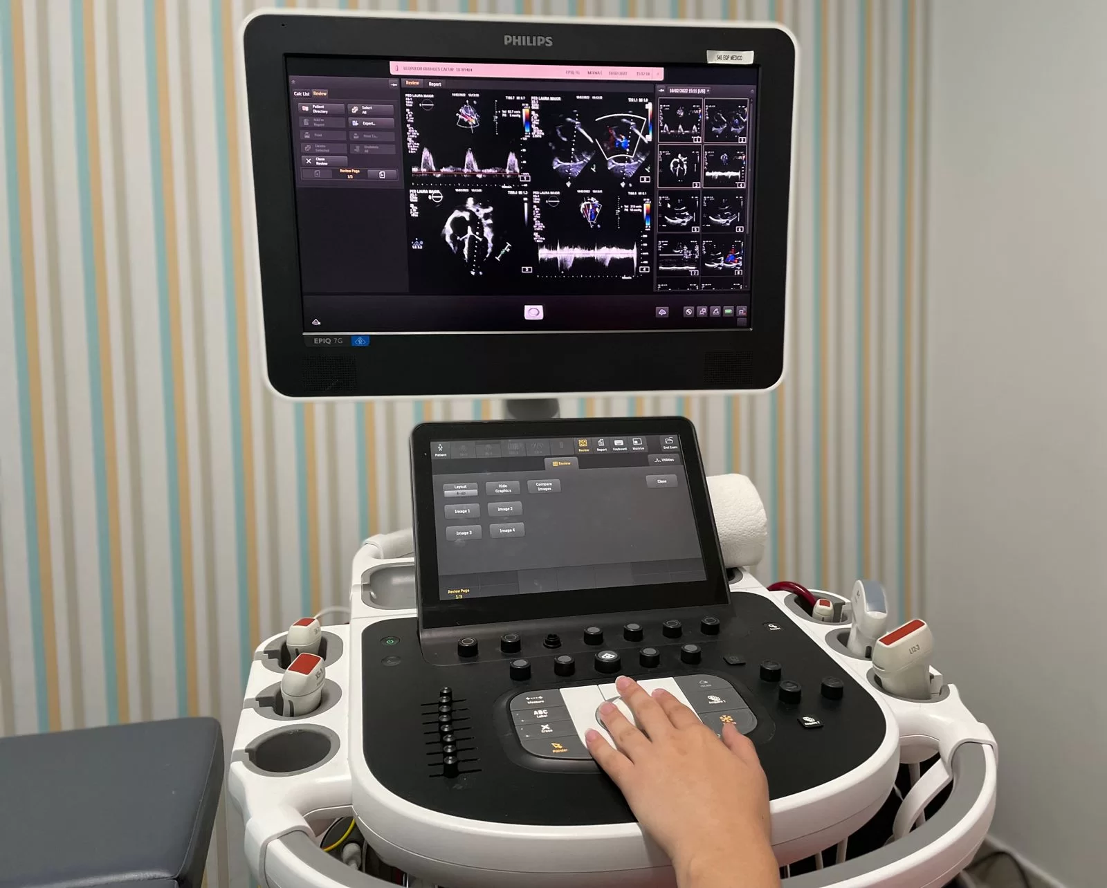 Doppler Colorido De Veia Cava Inferior E Veias Ilíacas